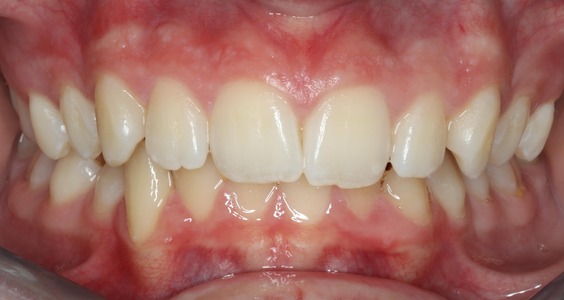 Before Teeth